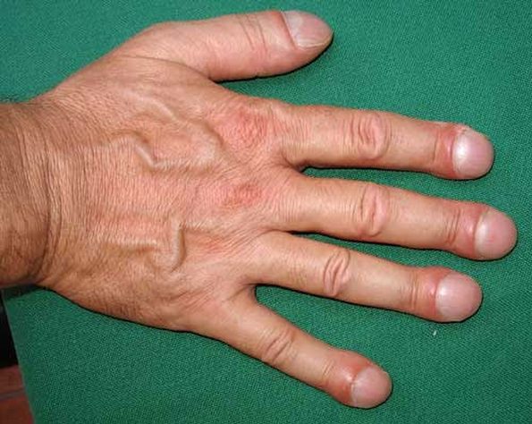 finger_penis_syndrome